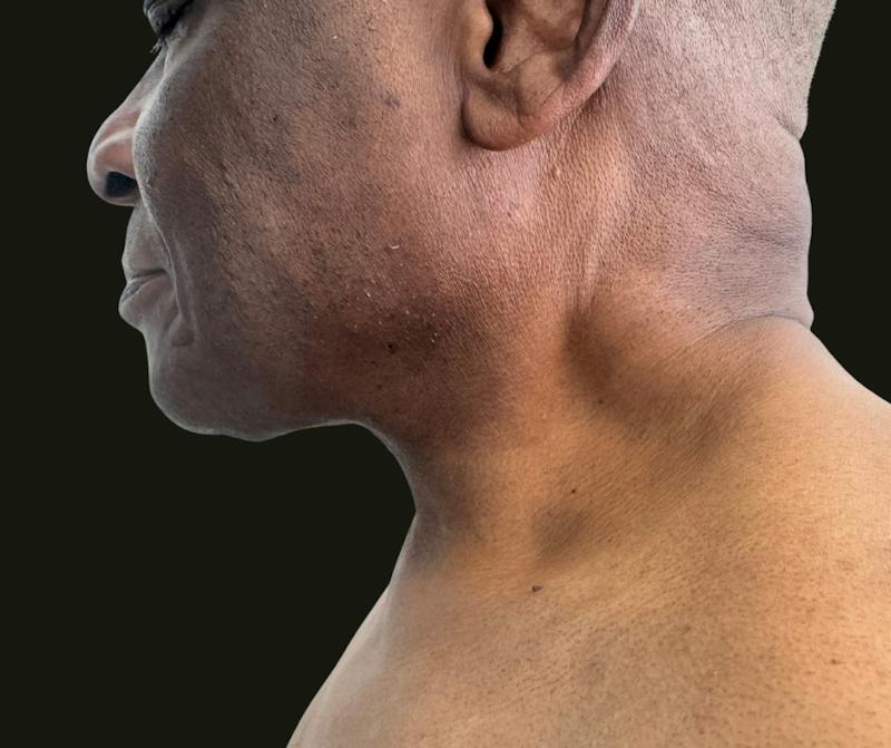 Cervicoplasty Before & After Gallery - Patient 119132 - Image 2
