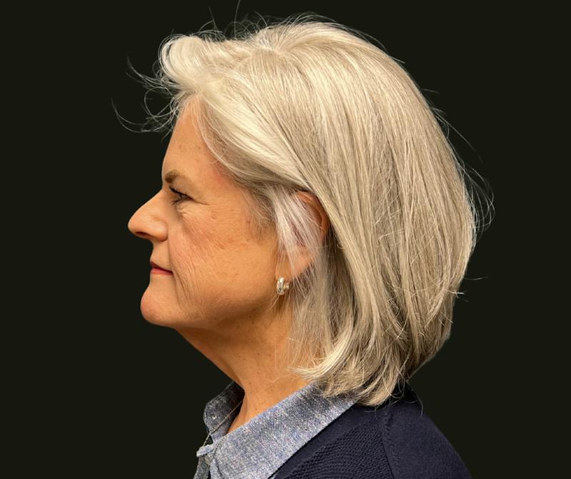 Cervicoplasty Before & After Gallery - Patient 131329 - Image 1
