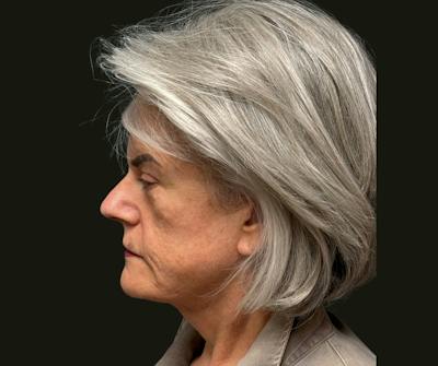Cervicoplasty Before & After Gallery - Patient 131329 - Image 2