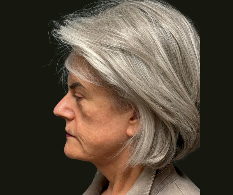 Cervicoplasty Before & After Gallery - Patient 131329 - Image 2