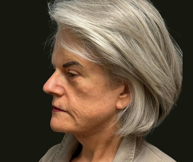 Cervicoplasty Before & After Gallery - Patient 131329 - Image 4