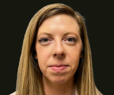 Chin Implant Before & After Gallery - Patient 277566 - Image 1