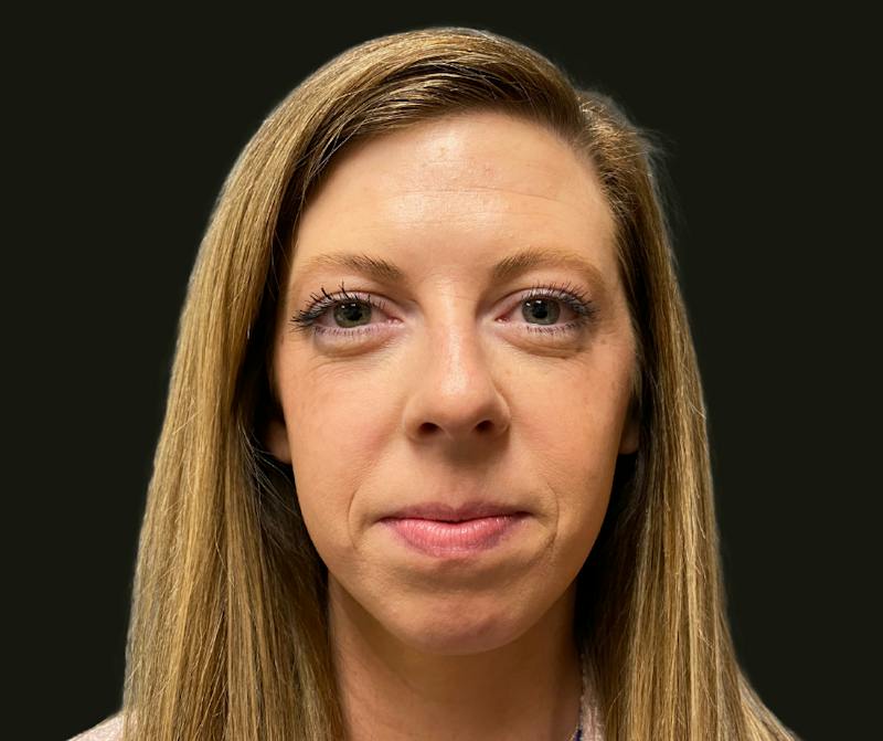 Chin Implant Before & After Gallery - Patient 277566 - Image 1
