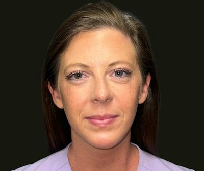 Chin Implant Before & After Gallery - Patient 277566 - Image 2