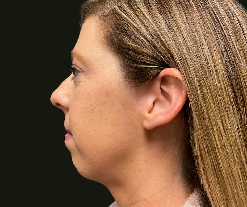 Chin Implant Before & After Gallery - Patient 277566 - Image 3