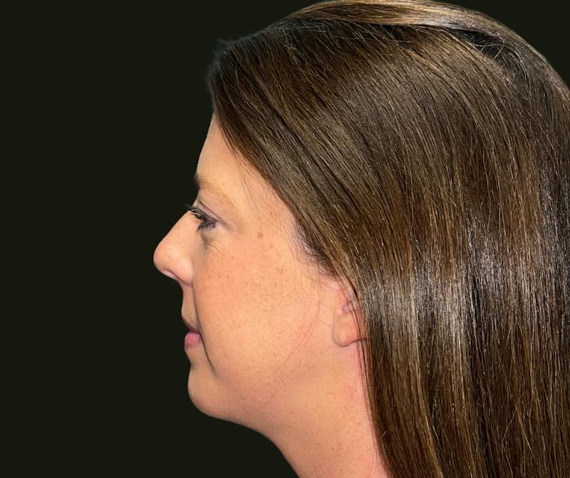Chin Implant Before & After Gallery - Patient 277566 - Image 4