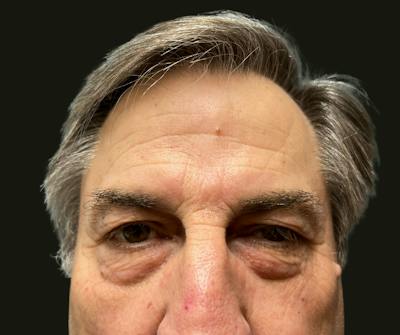Direct Brow Before & After Gallery - Patient 374715 - Image 1
