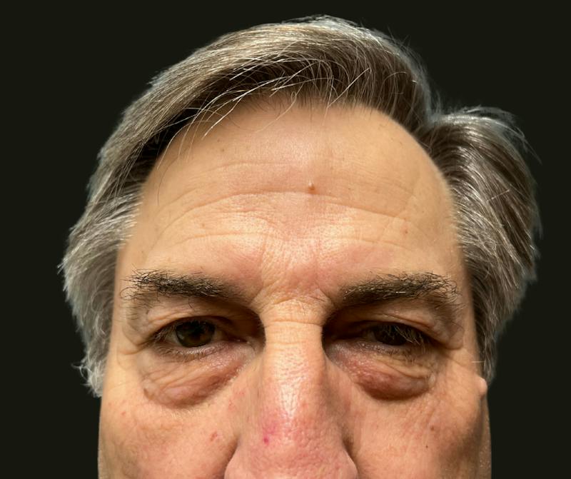 Direct Brow Before & After Gallery - Patient 374715 - Image 1