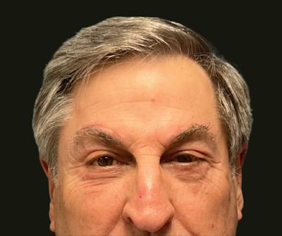 Direct Brow Before & After Gallery - Patient 374715 - Image 2
