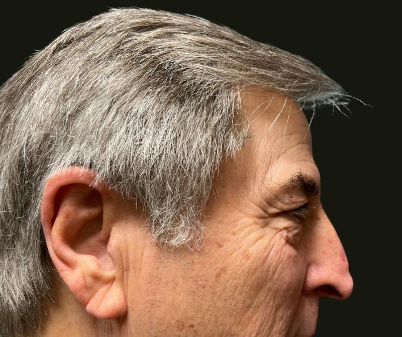 Direct Brow Before & After Gallery - Patient 374715 - Image 3