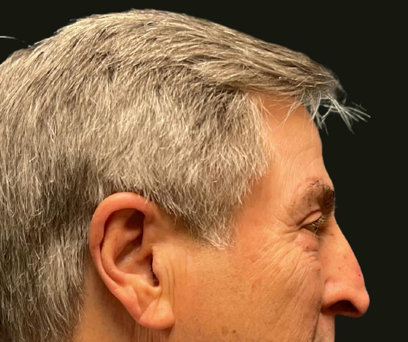 Direct Brow Before & After Gallery - Patient 374715 - Image 4