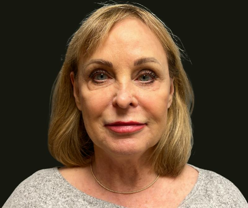 Full Face Rejuvenation Before & After Gallery - Patient 385274 - Image 1