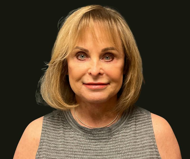 Full Face Rejuvenation Before & After Gallery - Patient 385274 - Image 2