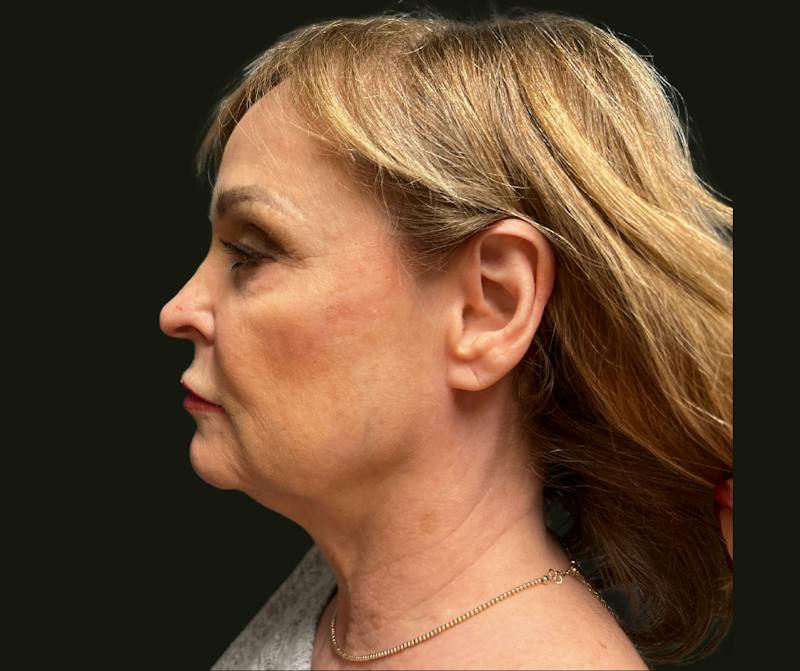 Full Face Rejuvenation Before & After Gallery - Patient 385274 - Image 3
