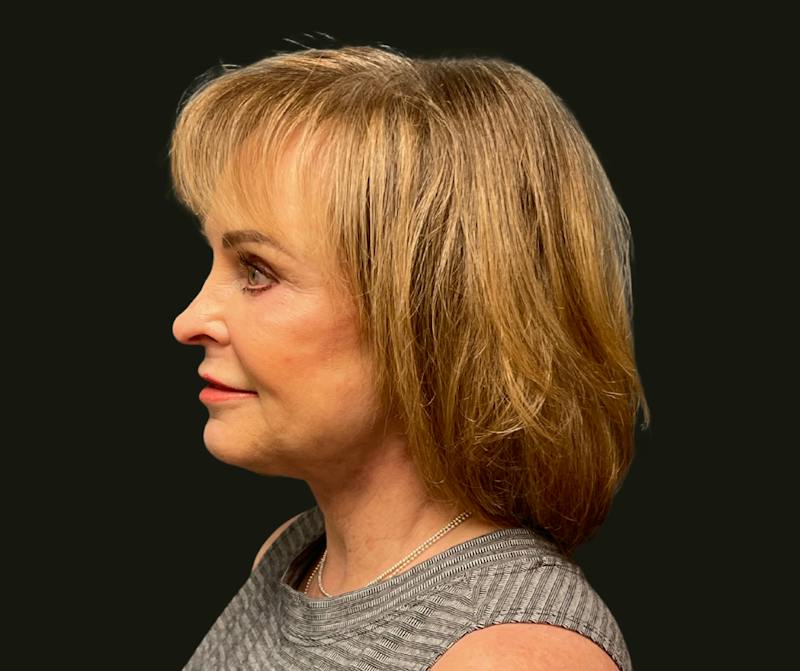 Full Face Rejuvenation Before & After Gallery - Patient 385274 - Image 4