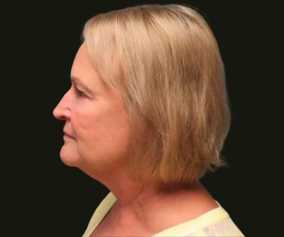 Full Face Rejuvenation Before & After Gallery - Patient 271062 - Image 1