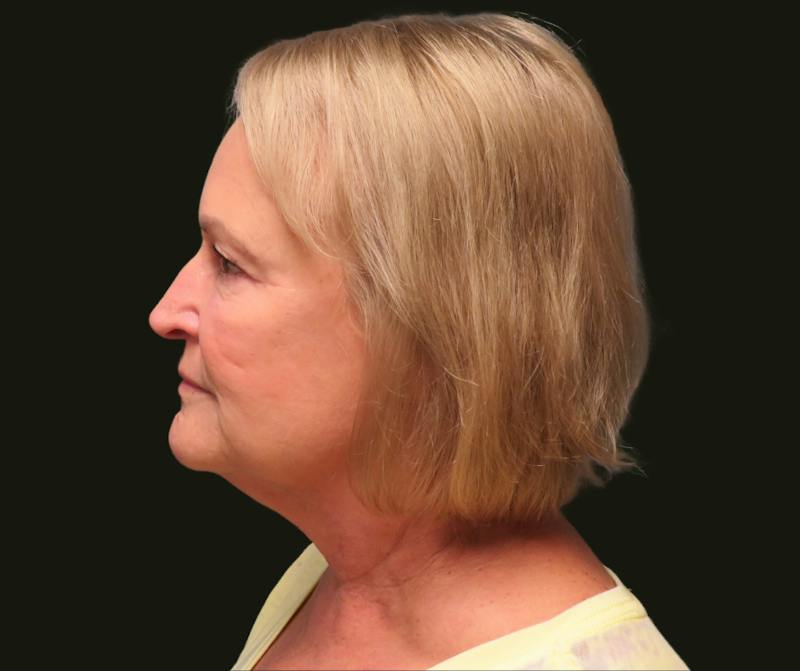 Full Face Rejuvenation Before & After Gallery - Patient 271062 - Image 1
