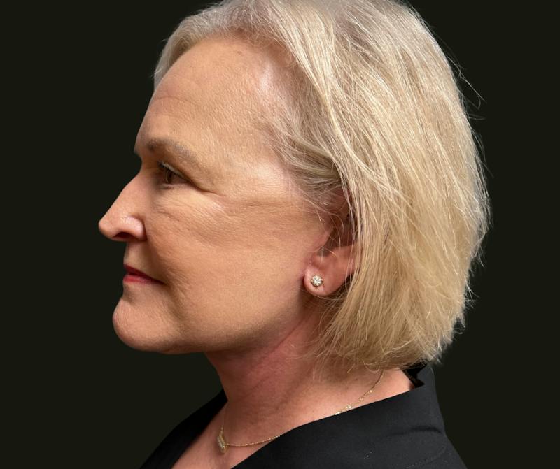 Full Face Rejuvenation Before & After Gallery - Patient 271062 - Image 2