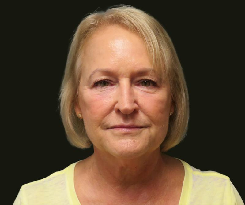 Full Face Rejuvenation Before & After Gallery - Patient 271062 - Image 3