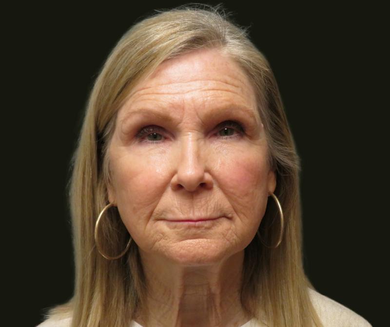 Full Face Rejuvenation Before & After Gallery - Patient 176662 - Image 1