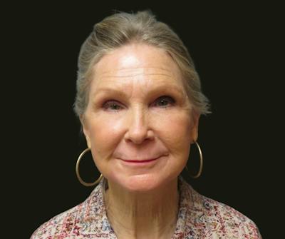 Full Face Rejuvenation Before & After Gallery - Patient 176662 - Image 2