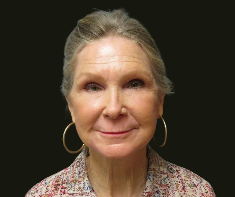 Full Face Rejuvenation Before & After Gallery - Patient 176662 - Image 2