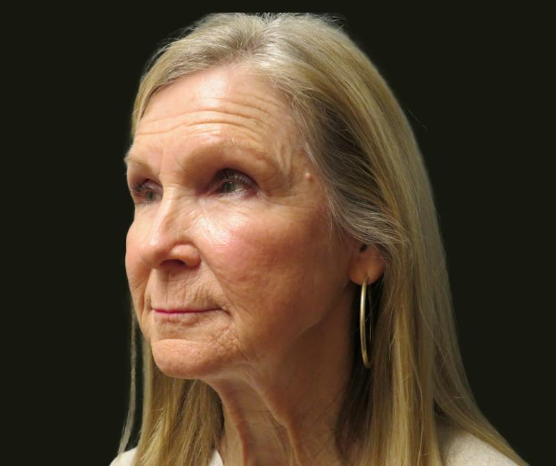 Full Face Rejuvenation Before & After Gallery - Patient 176662 - Image 3