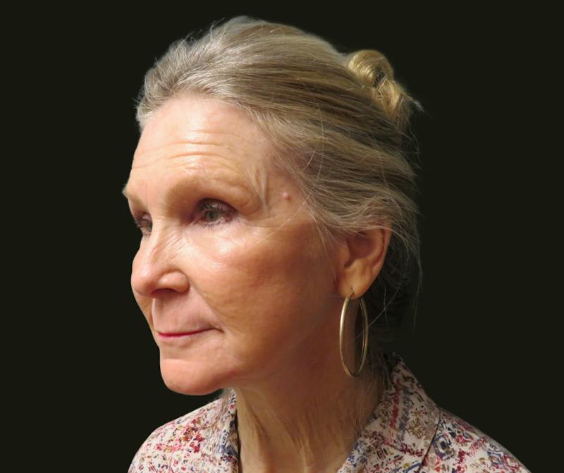 Full Face Rejuvenation Before & After Gallery - Patient 176662 - Image 4