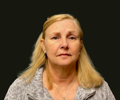 Full Face Rejuvenation Before & After Gallery - Patient 616186 - Image 1