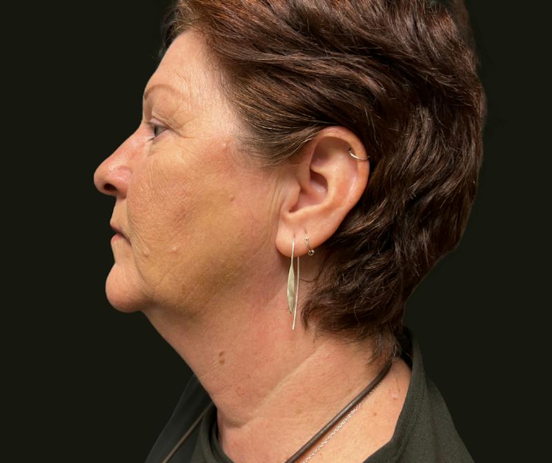 Full Face Rejuvenation Before & After Gallery - Patient 417583 - Image 1