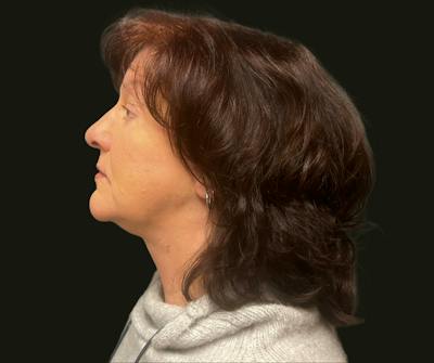 Full Face Rejuvenation Before & After Gallery - Patient 417583 - Image 2
