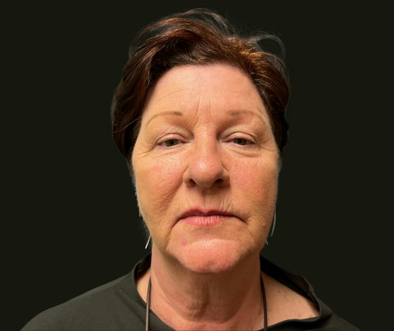 Full Face Rejuvenation Before & After Gallery - Patient 417583 - Image 3
