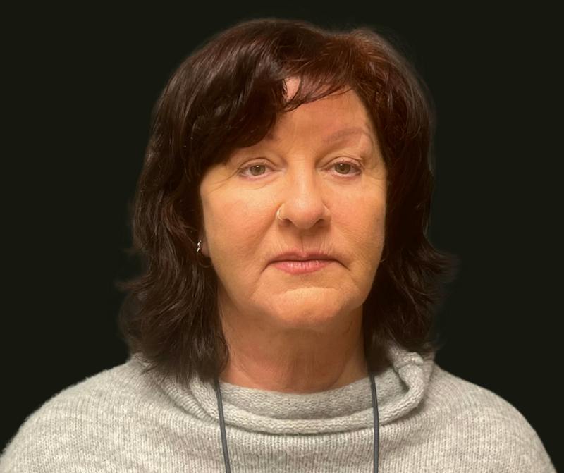 Full Face Rejuvenation Before & After Gallery - Patient 417583 - Image 4