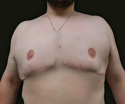 Gynecomastia Before & After Gallery - Patient 457821 - Image 2