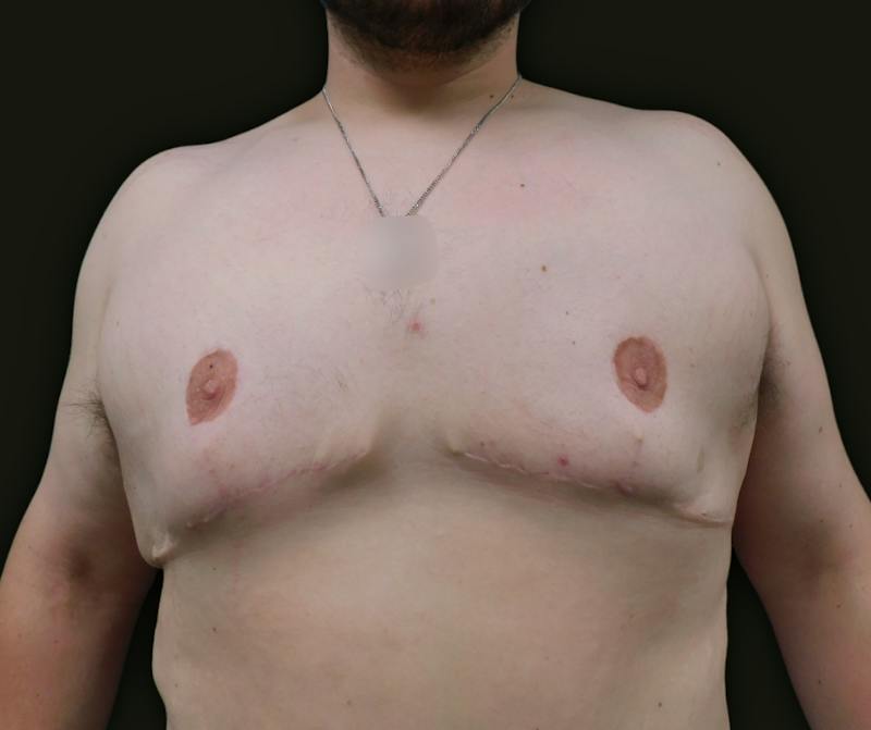 Gynecomastia Before & After Gallery - Patient 457821 - Image 2