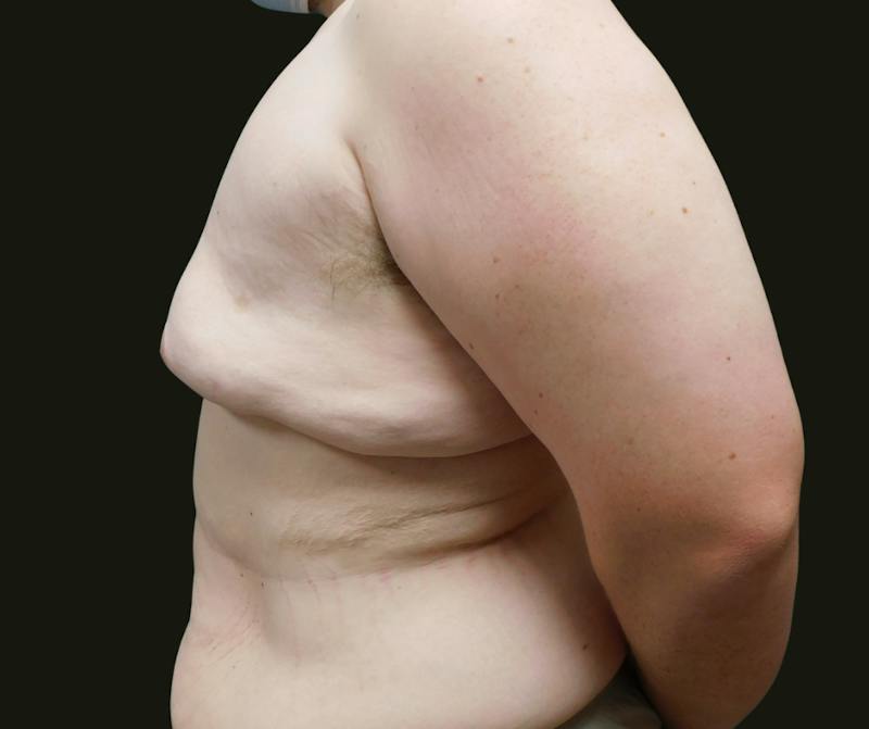 Gynecomastia Before & After Gallery - Patient 457821 - Image 3
