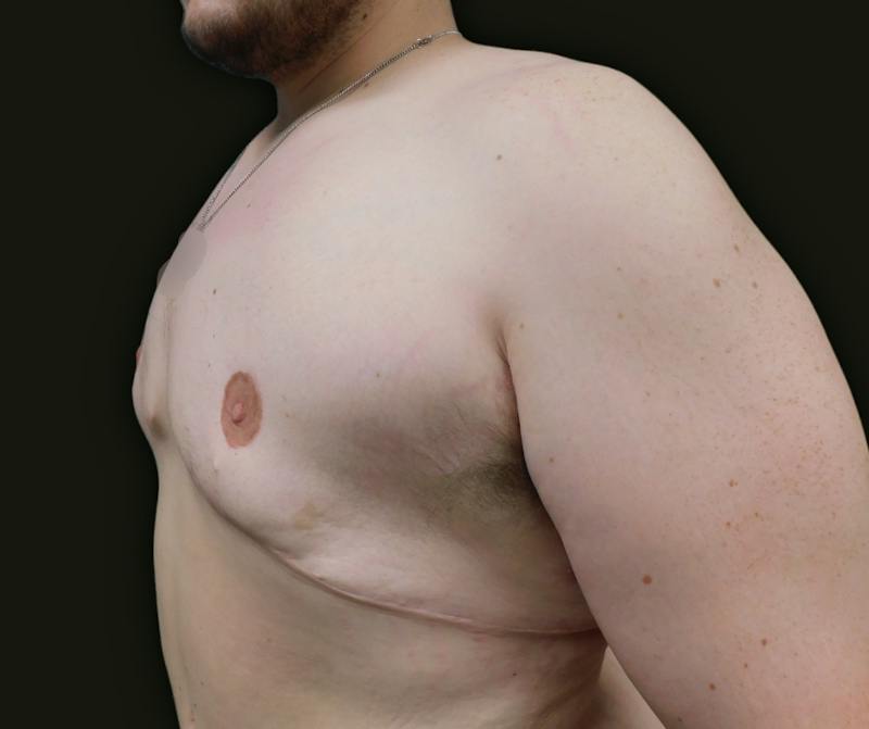 Gynecomastia Before & After Gallery - Patient 457821 - Image 4