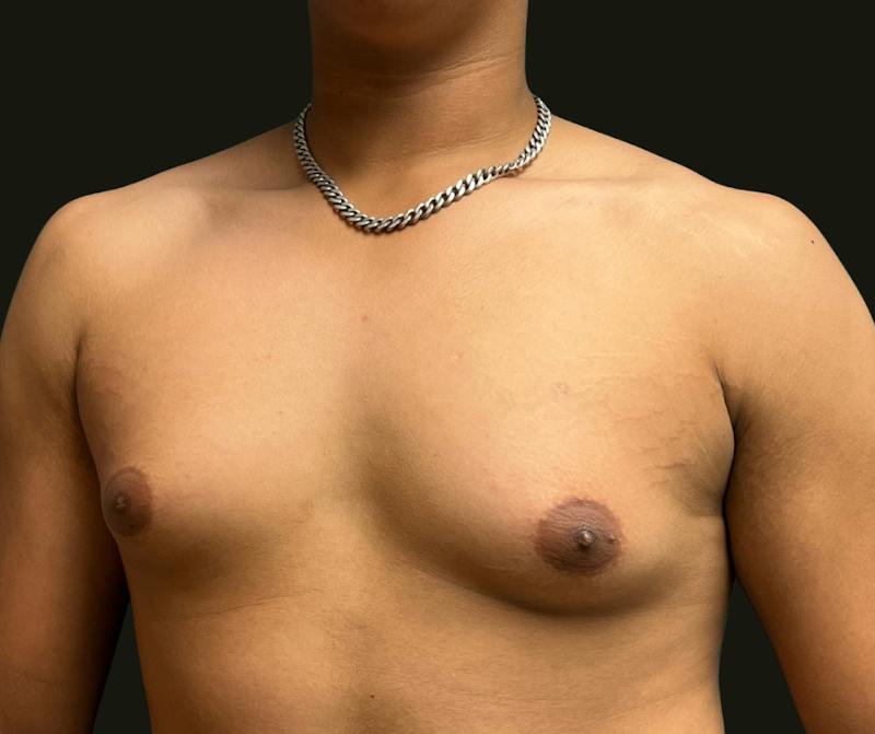 Gynecomastia Before & After Gallery - Patient 260732 - Image 1