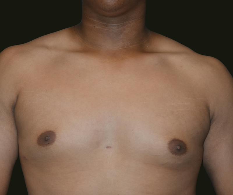 Gynecomastia Before & After Gallery - Patient 260732 - Image 2