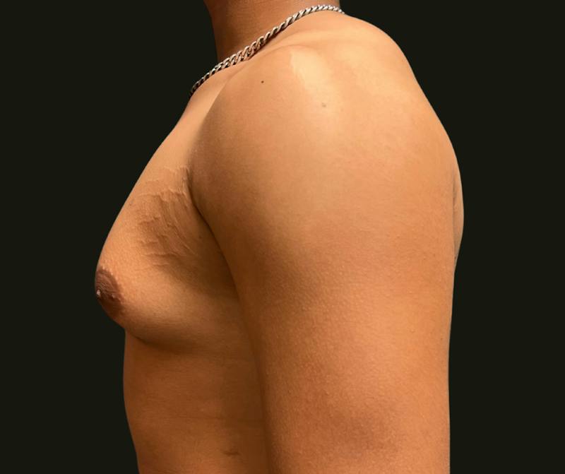 Gynecomastia Before & After Gallery - Patient 260732 - Image 3