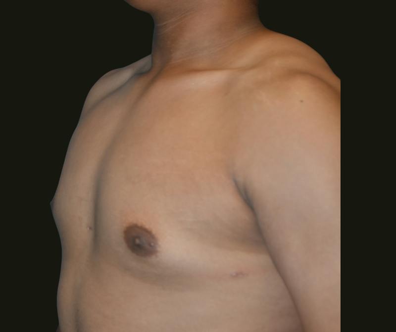Gynecomastia Before & After Gallery - Patient 260732 - Image 4