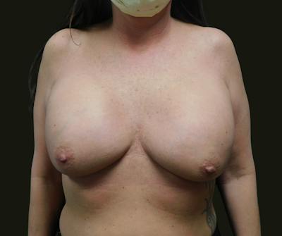 Implant Exchange Before & After Gallery - Patient 254879 - Image 1