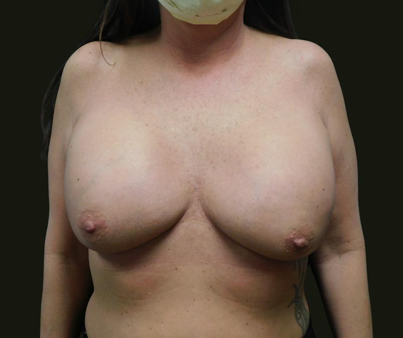 Implant Exchange Before & After Gallery - Patient 254879 - Image 1