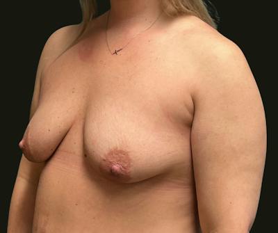 Mastopexy Aug Before & After Gallery - Patient 136989 - Image 1
