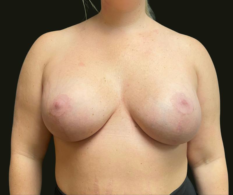 Mastopexy Aug Before & After Gallery - Patient 136989 - Image 4