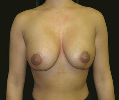 Mastopexy Aug Before & After Gallery - Patient 383516 - Image 2