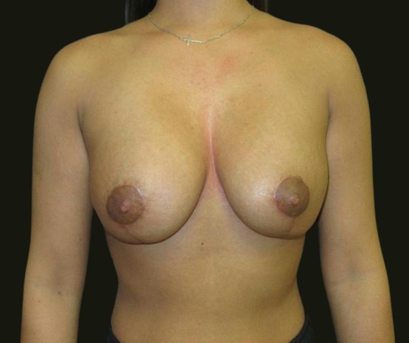 Mastopexy Aug Before & After Gallery - Patient 383516 - Image 2