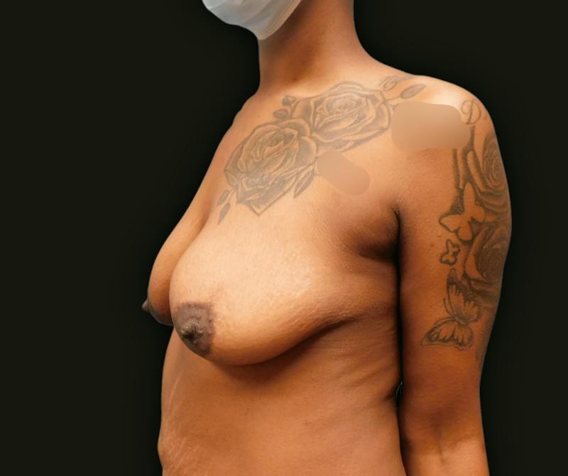 Mommy Makeover Before & After Gallery - Patient 335785 - Image 3