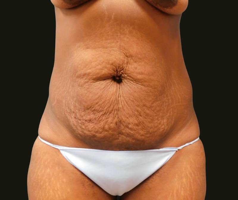 Mommy Makeover Before & After Gallery - Patient 335785 - Image 5