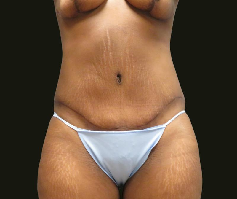 Mommy Makeover Before & After Gallery - Patient 335785 - Image 6